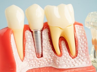 painless root canal treatment image aruna dental hospital tadepalli