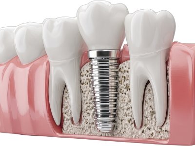 titanium implants image aruna dental hospital tadepalli