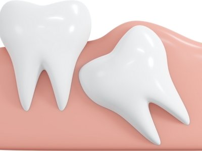 wisdom teeth removal image aruna dental hospital tadepalli